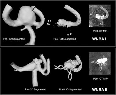 Virtual Flow-T Stenting for Two Patient-Specific Bifurcation Aneurysms